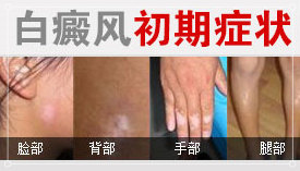 白癜风初期症状_副本.jpg