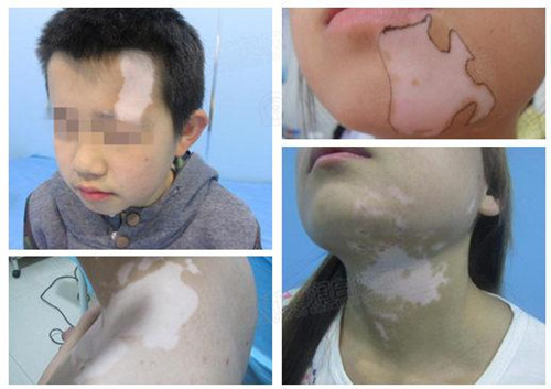 白斑蔓延给患者带来沉重的生活、心理压力